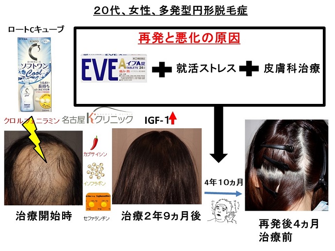 円形脱毛症　病院